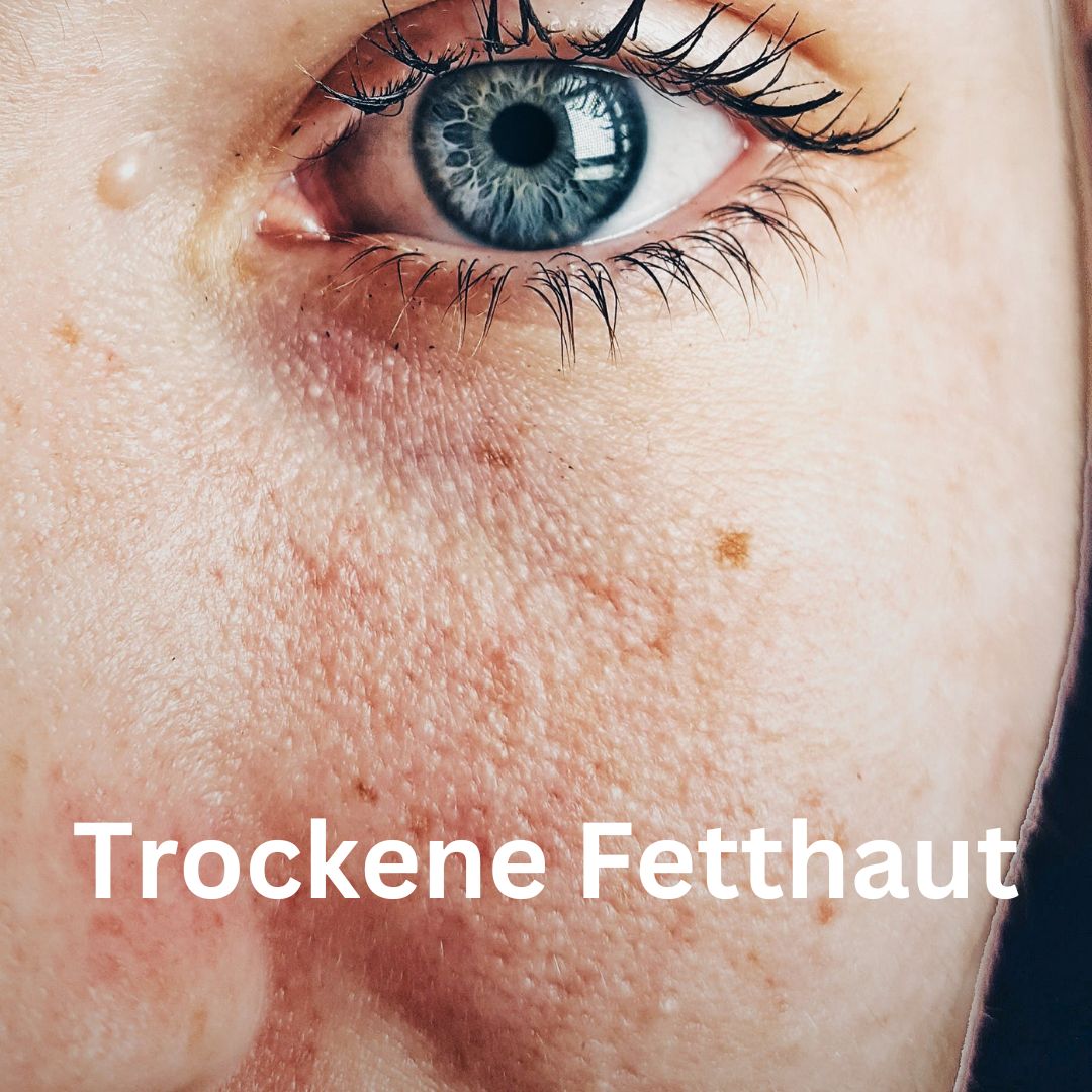 Trockene Fetthaut