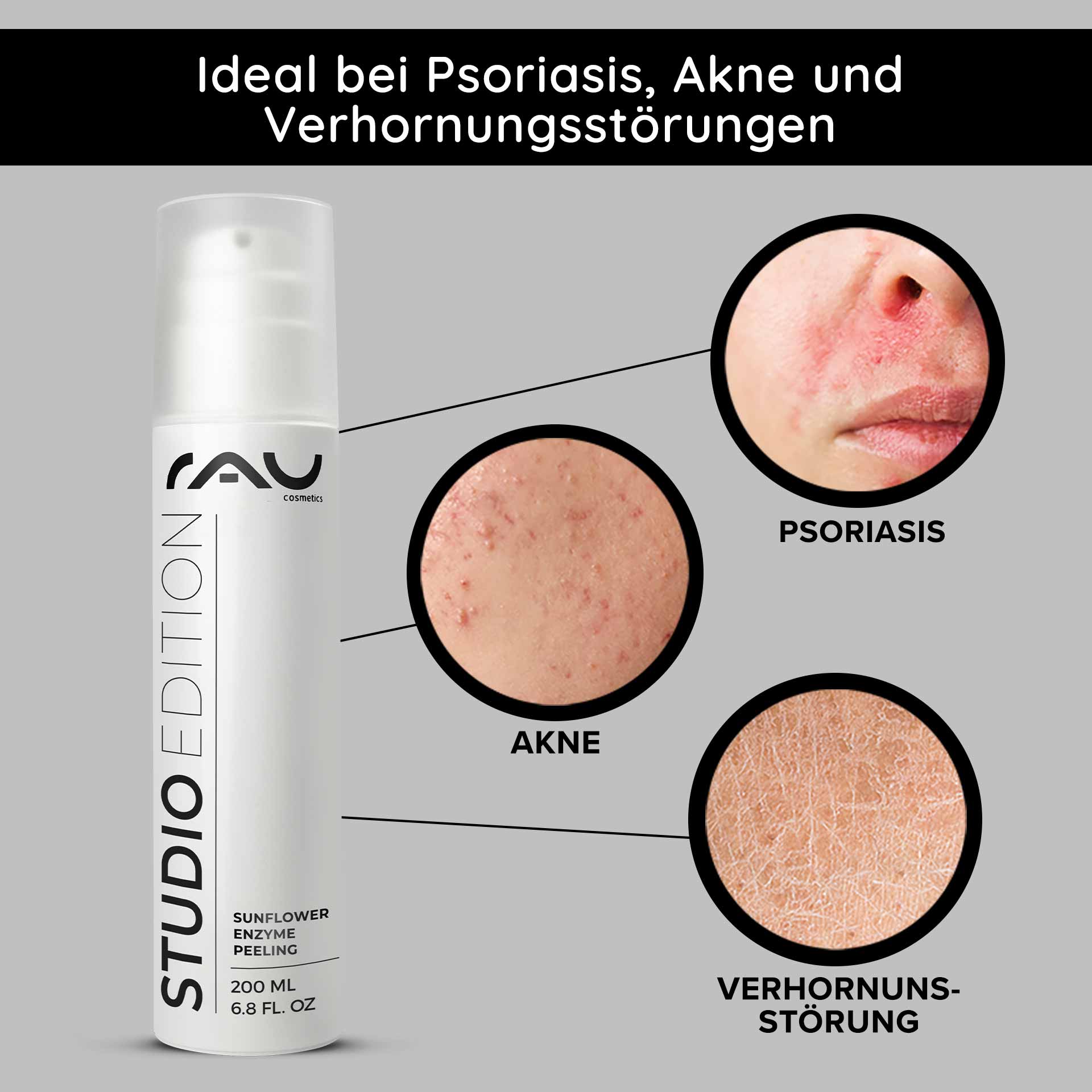 向日葵酵素去角质 200 毫升 化学酵素去角质 Verpackung des RAU Sunflower Enzyme Peeling mit hervorgehobenen Vorteilen bei Schuppenflechte, Akne und Keratose; Nahaufnahmen von Hautzuständen veranschaulichen die Wirksamkeit.